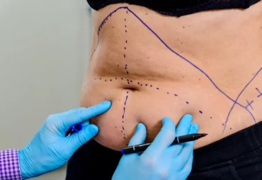 Understanding Tummy Tuck Surgery with TrustMed Clinic