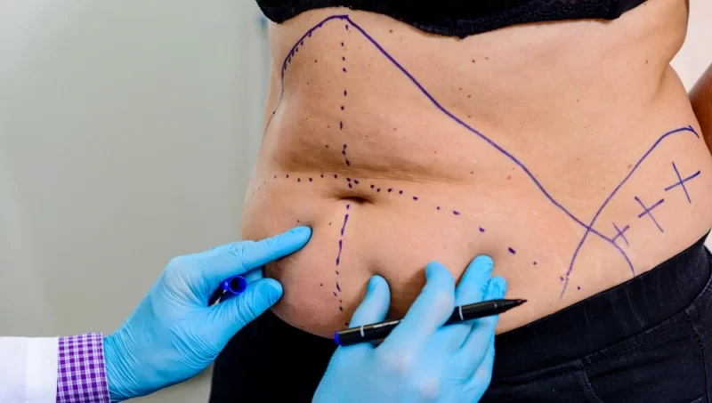 Understanding Tummy Tuck Surgery with TrustMed Clinic