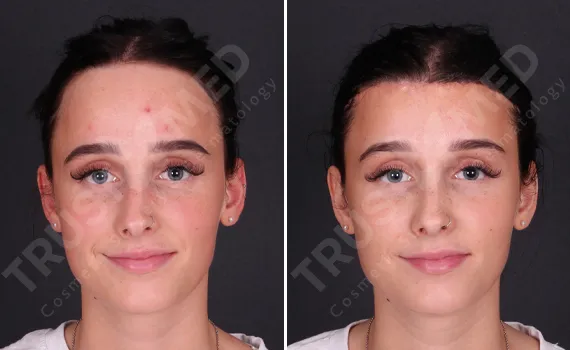 Forehead Reduction