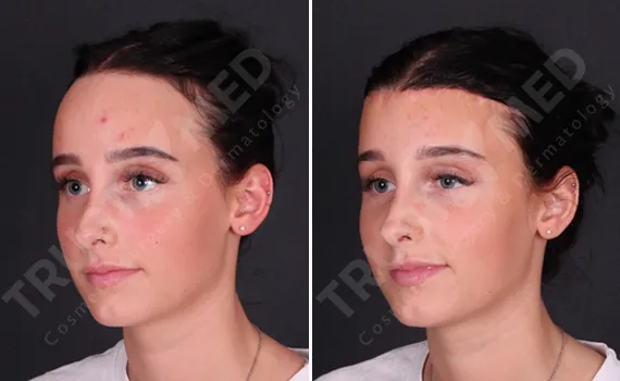 Forehead Reduction