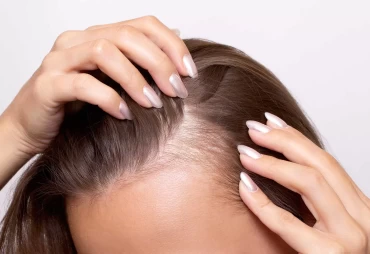 A Guide to Female Hair Transplants in Turkey: Restoring Confidence and Volume