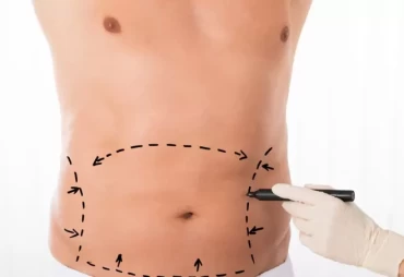 A Man's Guide to Abdominal Transformation: Tummy Tuck Surgery in Turkey