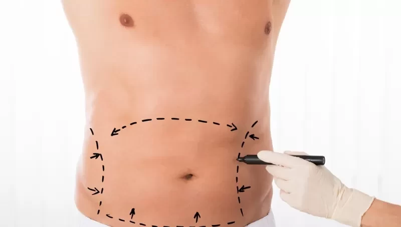 A Man's Guide to Abdominal Transformation: Tummy Tuck Surgery in Turkey