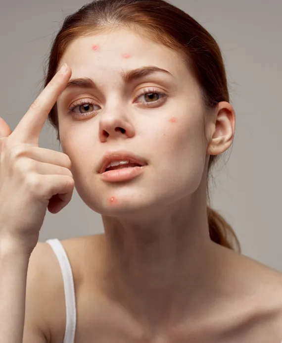 Acne Scar Treatment