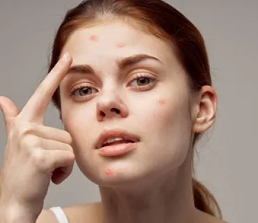 Acne Scar Treatment