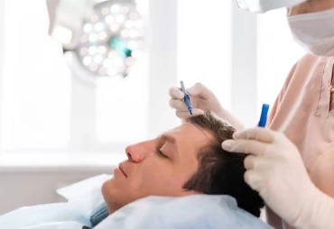 DHI vs. FUE Hair Transplants: Cost, Recovery, and Results Explained