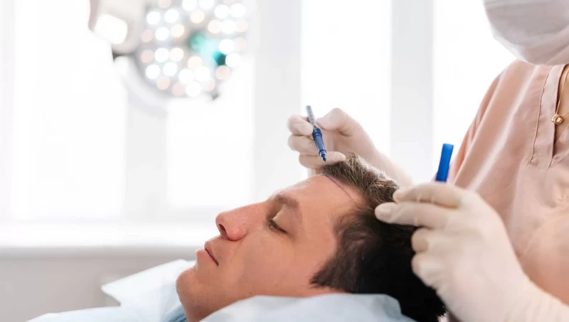 DHI vs. FUE Hair Transplants: Cost, Recovery, and Results Explained