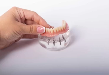 Everything You Need to Know About All-on-Four Dental Implants