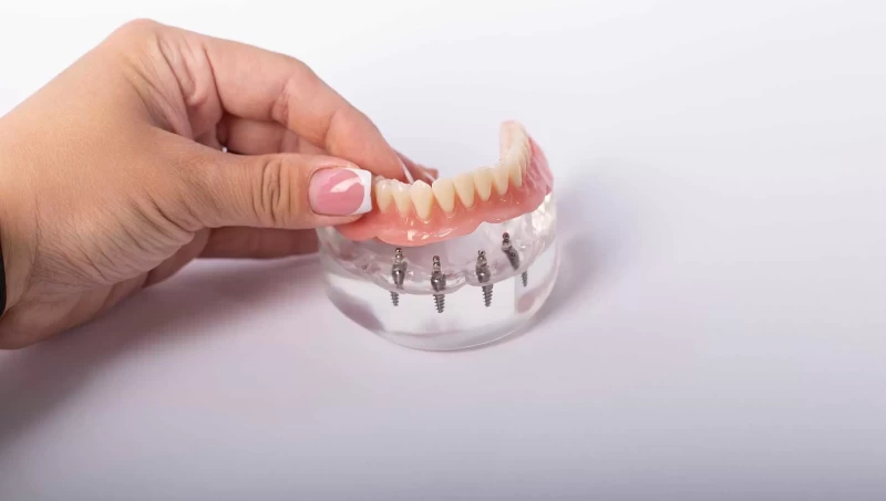 Everything You Need to Know About All-on-Four Dental Implants