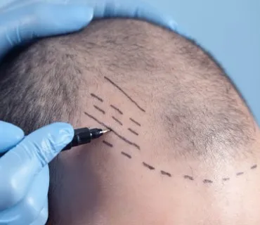 Fut Hair Transplant Surgery