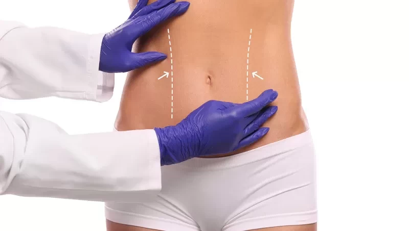 High-Definition Liposuction vs. Conventional Methods