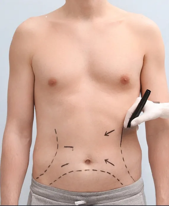 Liposuction for Men