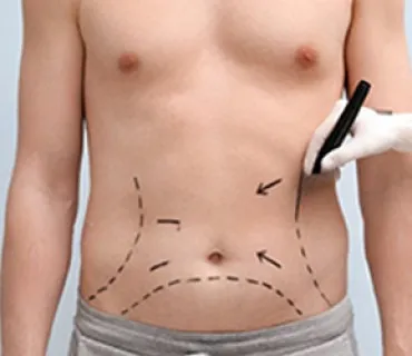 Liposuction for Men