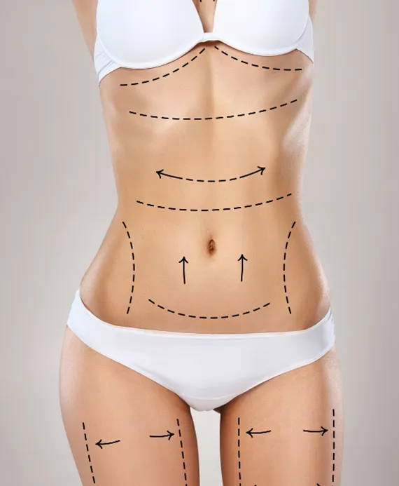 Liposuction