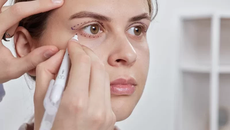 Preparing for Lower Blepharoplasty: Tips for a Smooth Surgery and Recovery