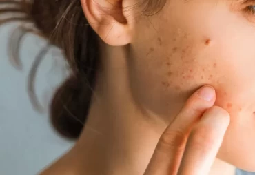 Scarred for What? Understanding Acne Scar Types and Treatment Strategies