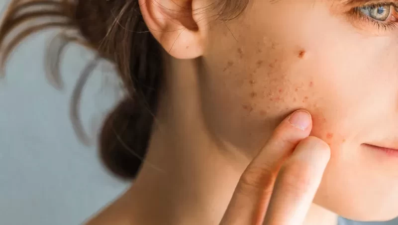 Scarred for What? Understanding Acne Scar Types and Treatment Strategies